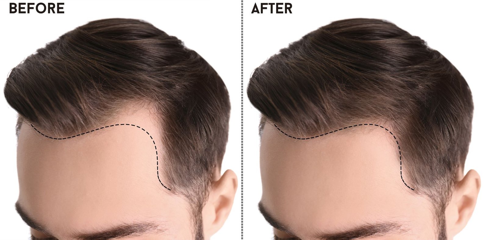 FUE Hairline Restoration Result